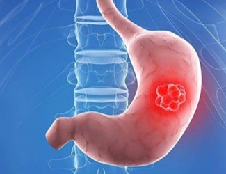 你知道嗎？從慢性胃炎到胃癌，只有四步！